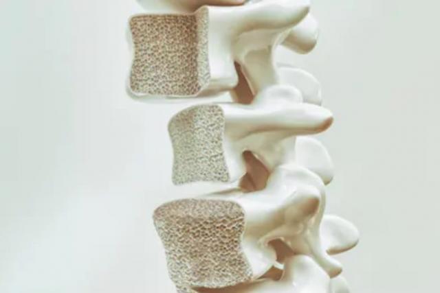 Osteoporosis, la enfermedad ósea más frecuente entre la población